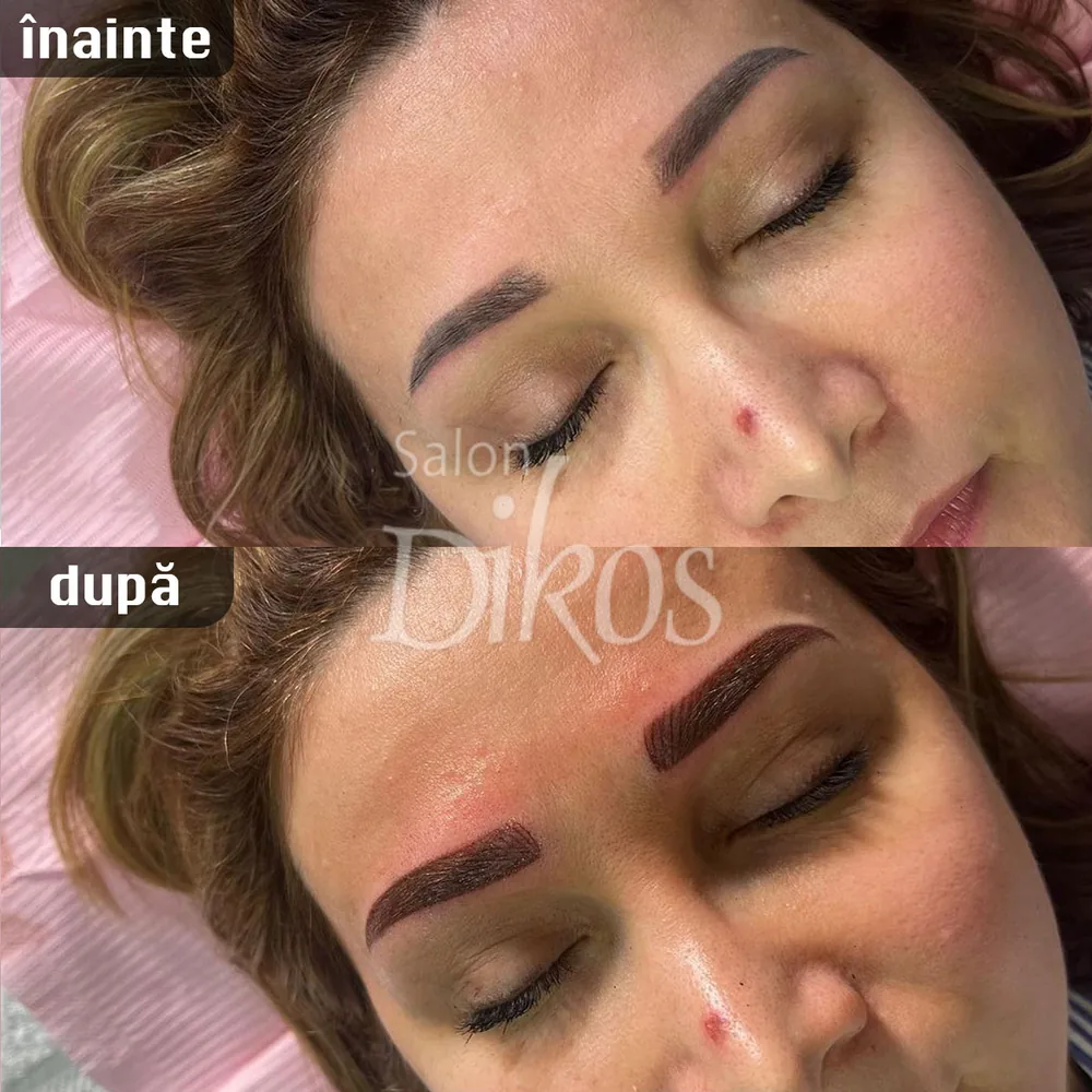 Tatuaje Sprancene - înainte și după - exemplul 27