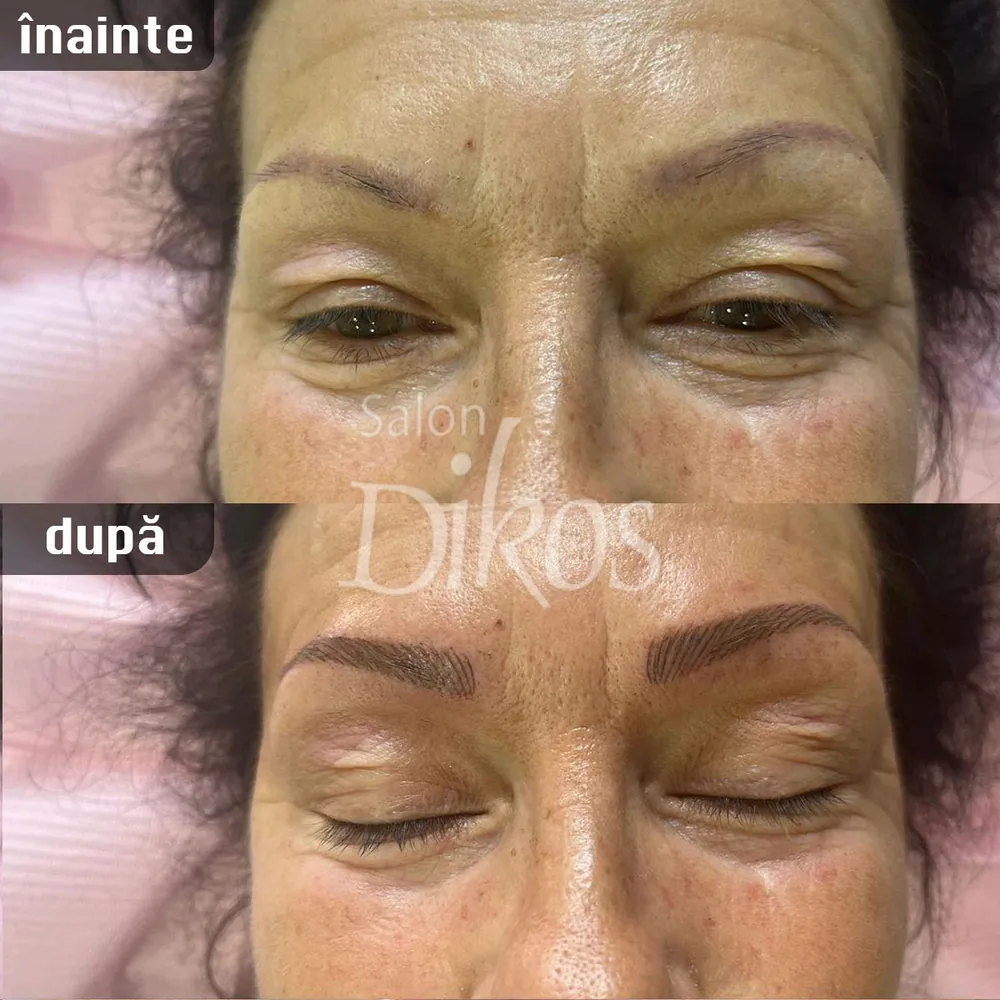 Tatuaje Sprancene - înainte și după - exemplul 17