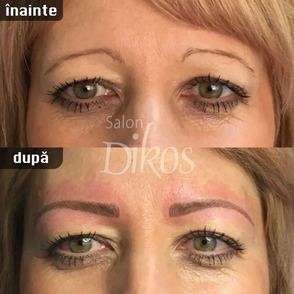 Tatuaje Sprancene - înainte și după - exemplul 7