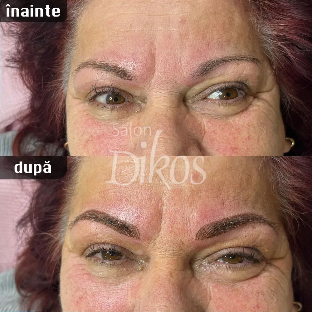 Tatuaje Sprancene - înainte și după - exemplul 32
