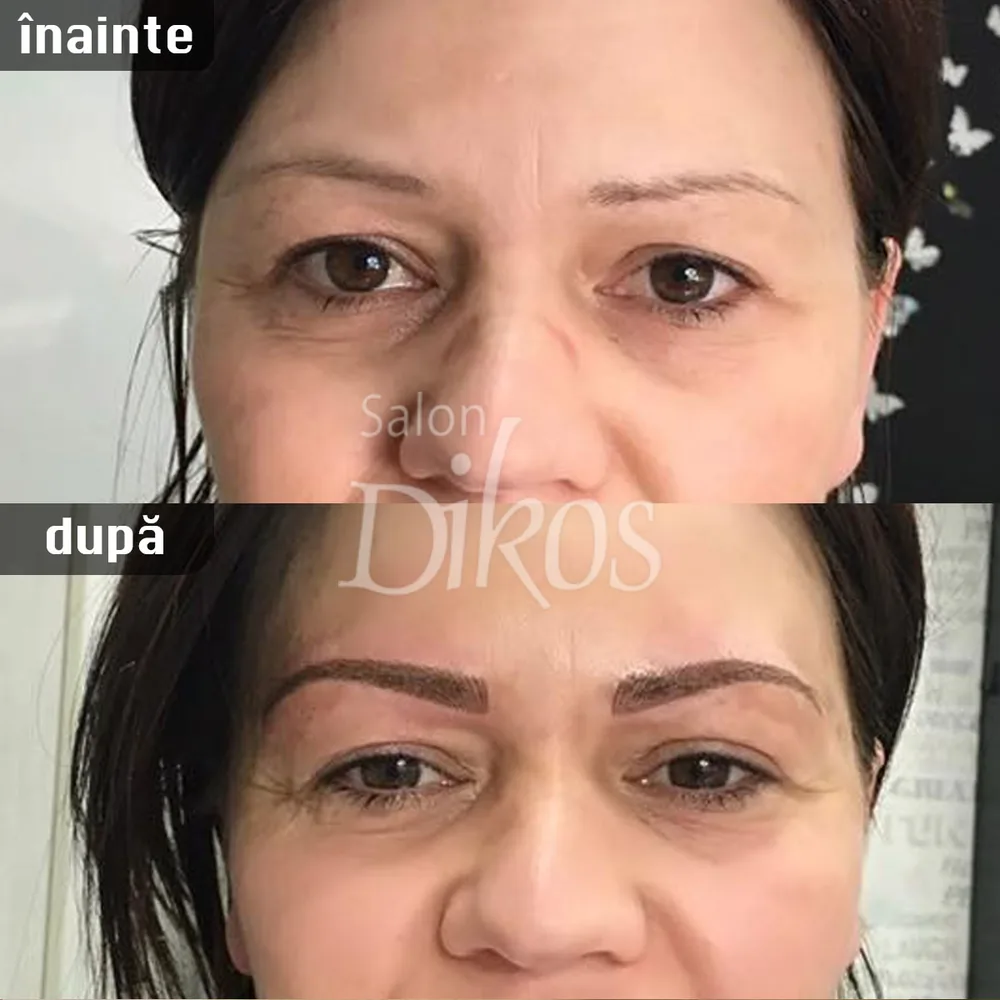 Tatuaje Sprancene - înainte și după - exemplul 12